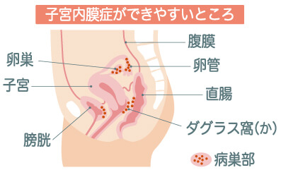子宮内膜症の図